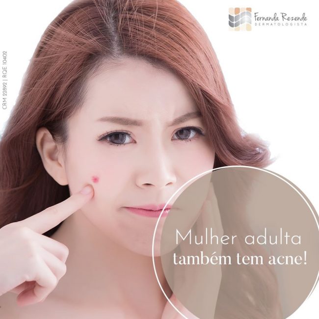 Acne na mulher adulta