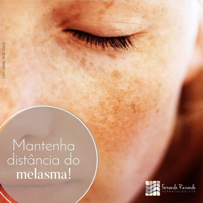 Melasma