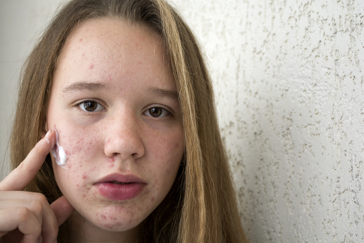 A teenager girl is going through because of acne on her face.A girl with problem skin touches pimples on her face. The girl is embarrassed by pimples on her face.