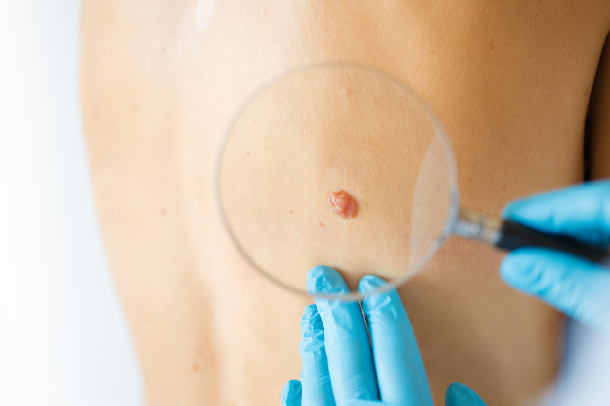 Close-up photo of dermatologist looking at birthmark on patient's skin