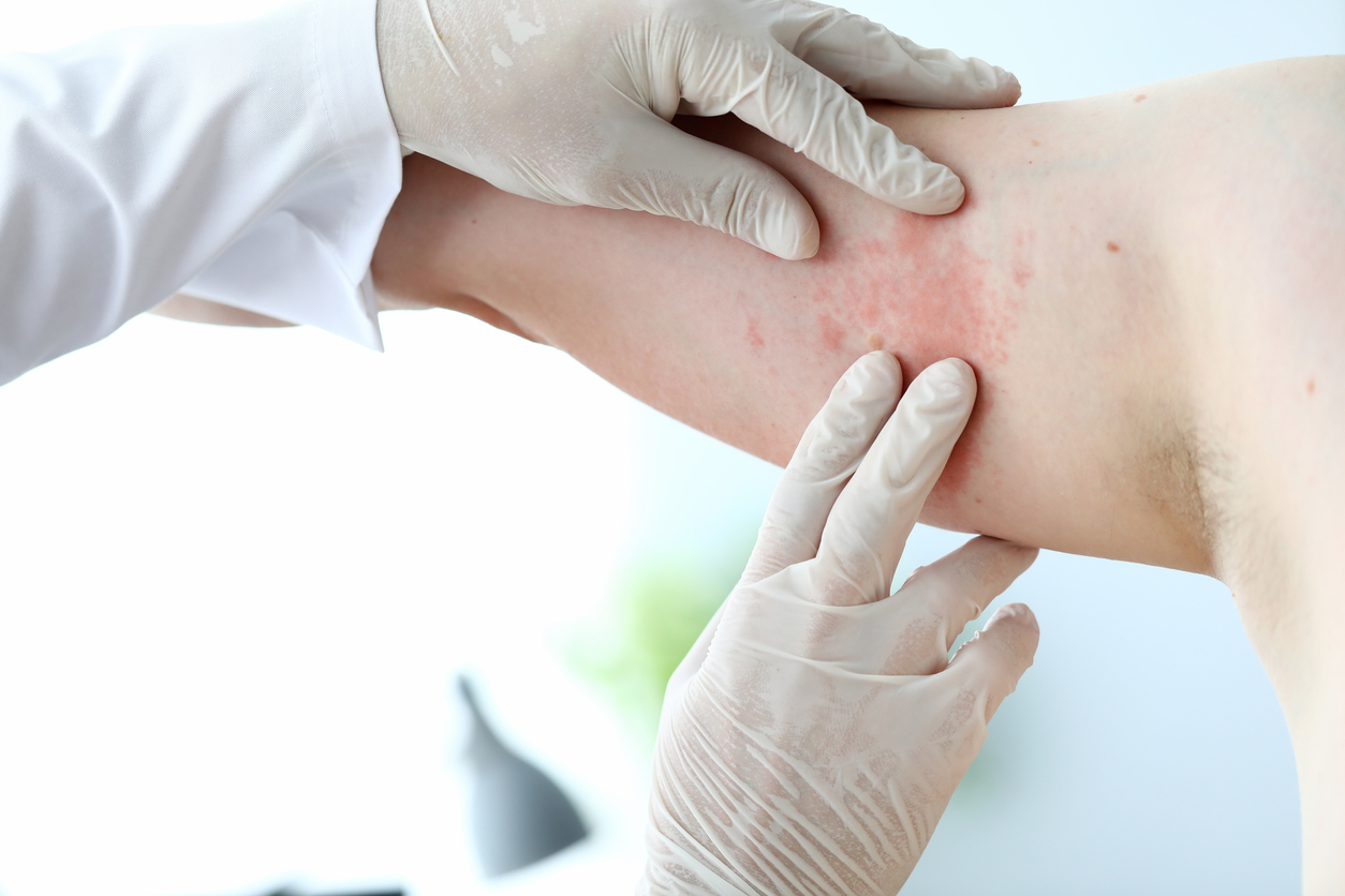 Male doctor in white latex gloves examines patient with skin disease against office background. Allergy treatment concept