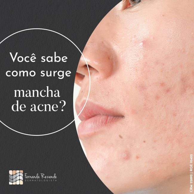 Manchas de acne