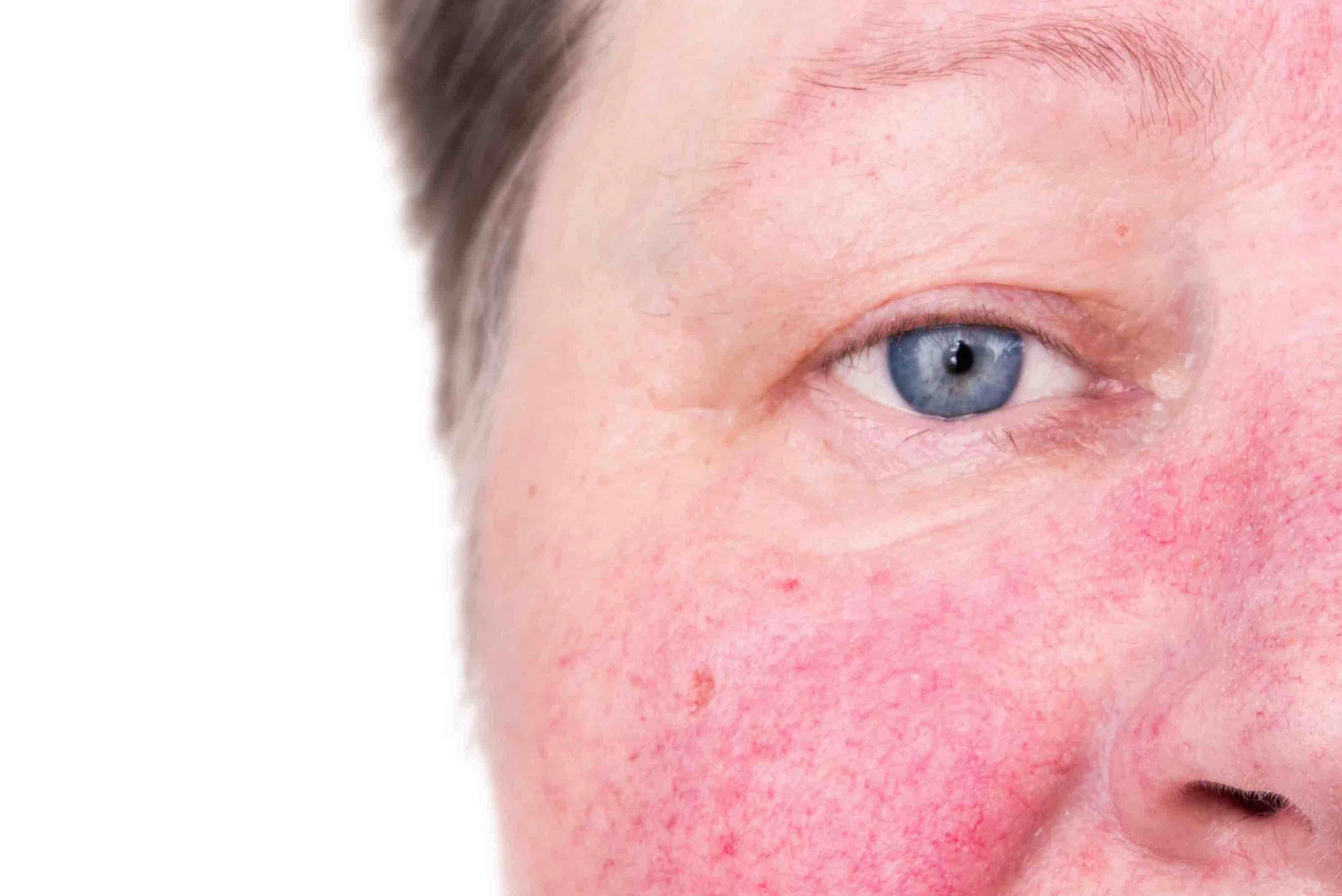 rosacea (1)